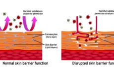 What is Corneotherapy?